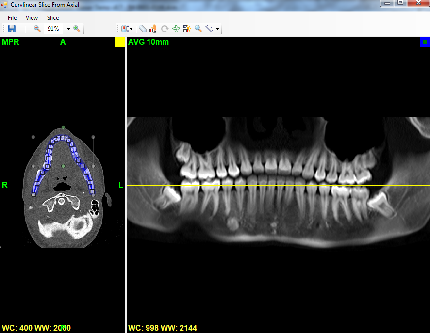 Screenshot of 2 image viewers, which display an axial DICOM MPR slice with curvilinear DICOM MPR slice